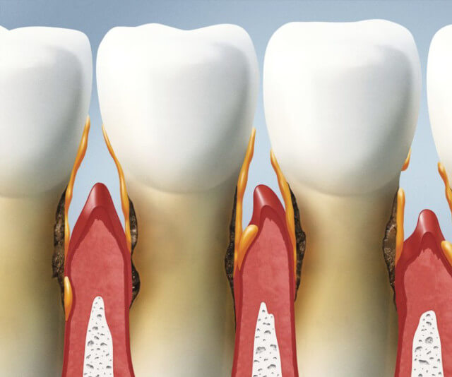 Clinica Teodent - Parodontologie laser