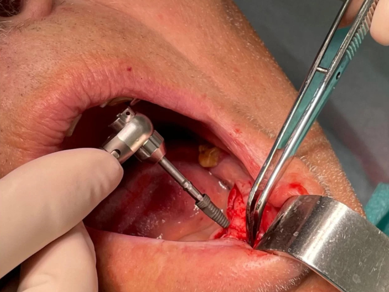 Clinica Teodent - Implant Dentar Fast & Fixed