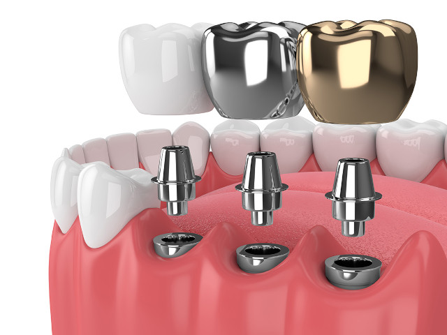 Clinica Teodent - Implant Dentar Personalizat