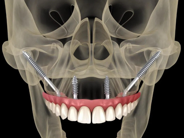 Clinica Teodent - Implant Dentar Zigomatic