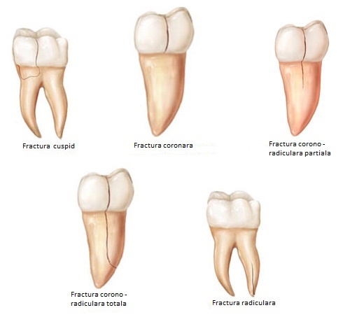 fracturi dentare