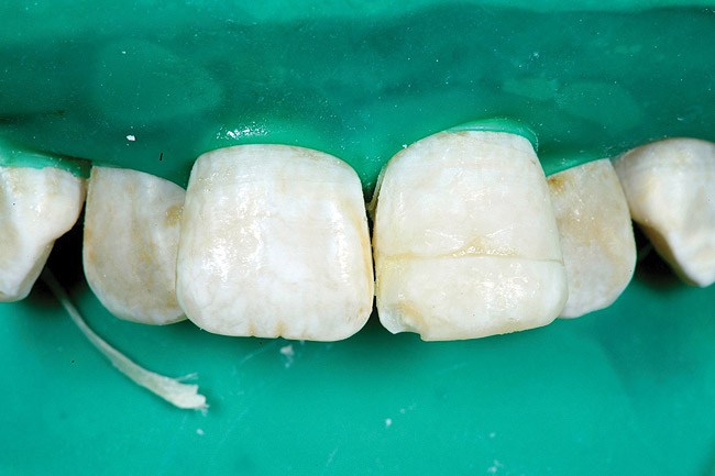 tratare fracturi dentare botosani
